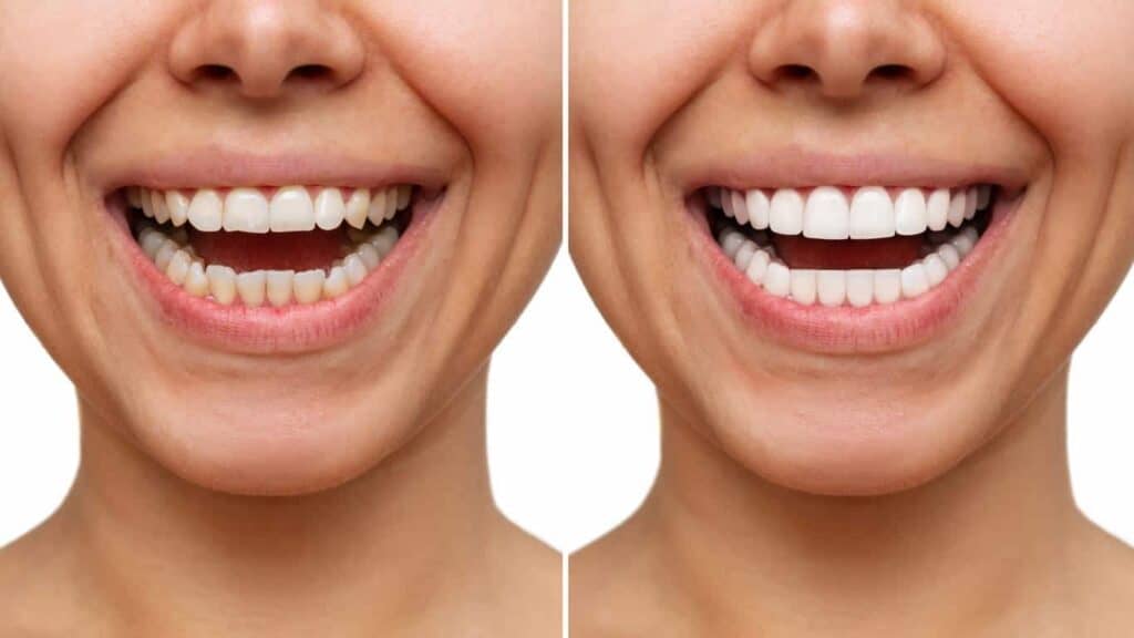 Before and after teeth whitening results. Bexley