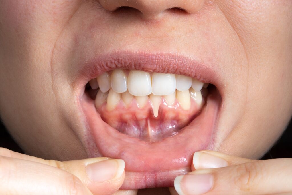 Preparing for teeth whitening with receding gums Bexley